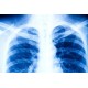 RTG на бели дробови и срце