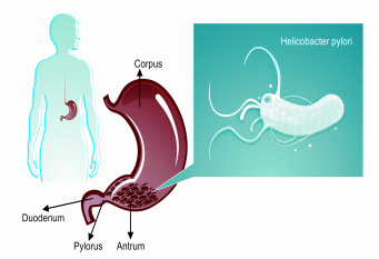 Dissertation h helicobacter infection pylori